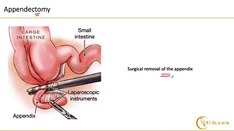 Appendectomy Appendicits Symptoms
